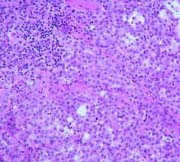 Mesothelioma Epithelioid type